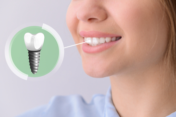 implant dentist expectations costs perth