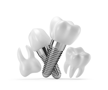 affordable dental implants perth