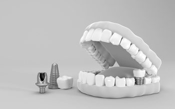 are tooth implants safe perth