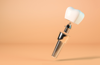 dental implant value perth
