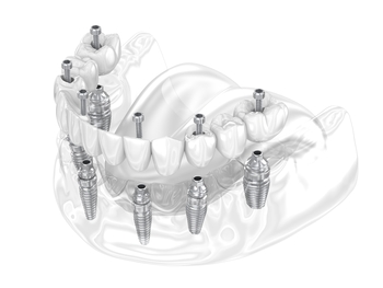 dental implants one only charges perth