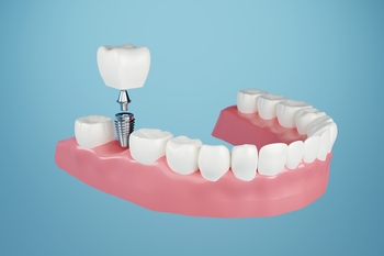 dental implants paying options perth
