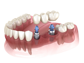 
implant dentist abroad perth