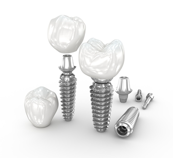 implant dentist expectations costs perth