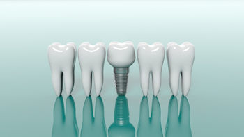implant dentist for seniors perth