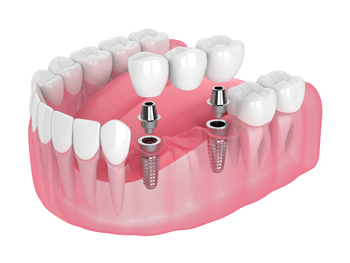 local teeth implant perth