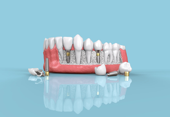 
low cost teeth implants perth
