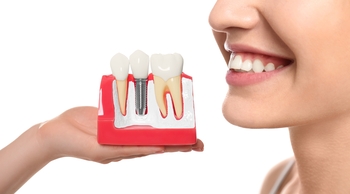 low price tooth implants perth