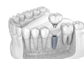 price teeth implant perth