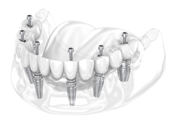 retiree dental implant perth
