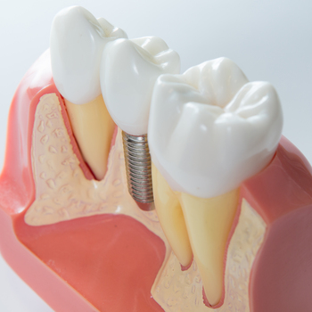 tooth implant expenses perth