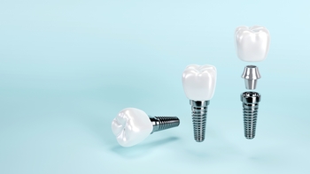 tooth implant overseas perth