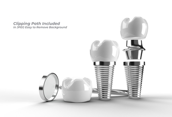 tooth implant process perth