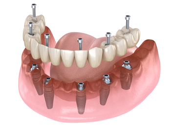 
tooth implants secure perth