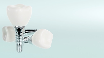 what do teeth implants look like perth