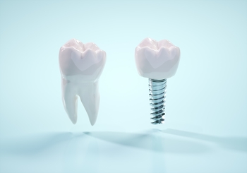 what do tooth implants looks like perth