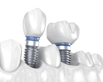 whats the price of teeth implant perth
