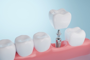 out of the country tooth implant perth