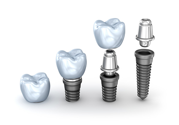 tooth implant overseas perth