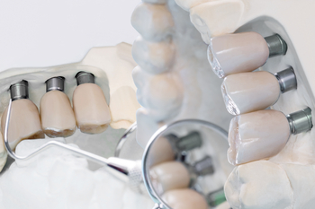 teeth implants philippines perth